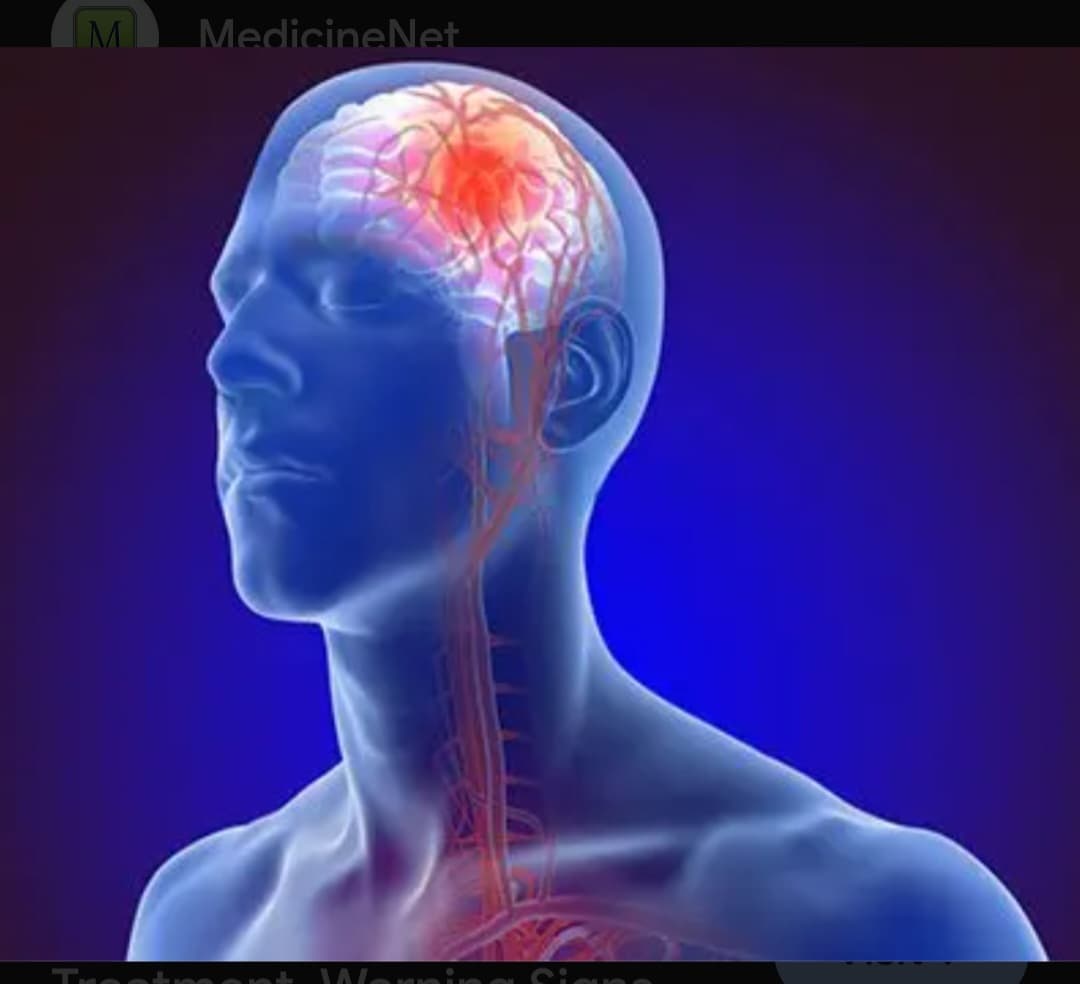 Stroke: Beyond the myths.